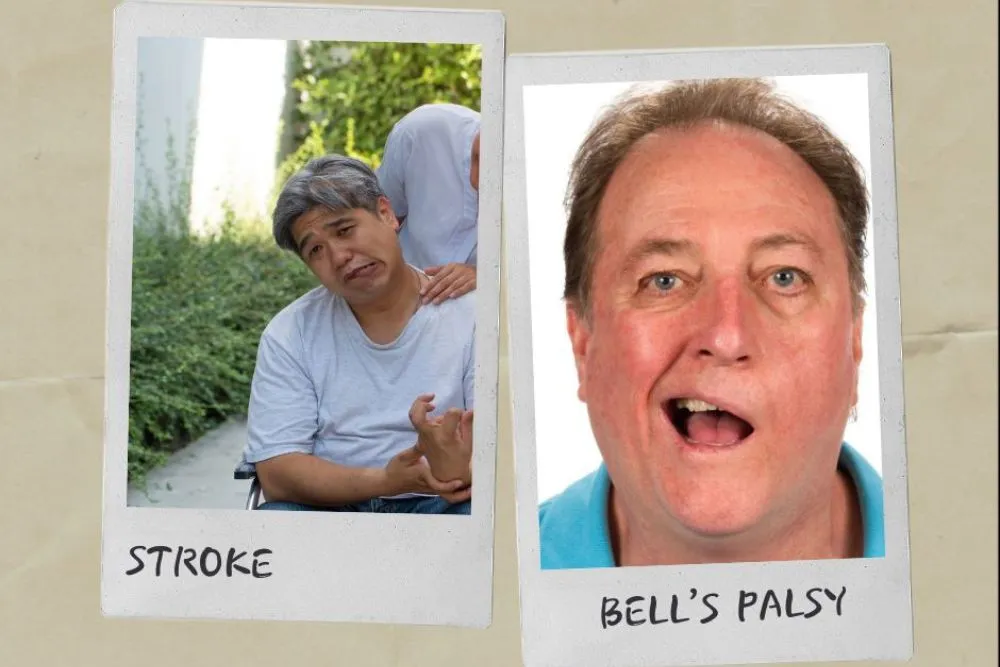 bell-s-palsy-medizzy